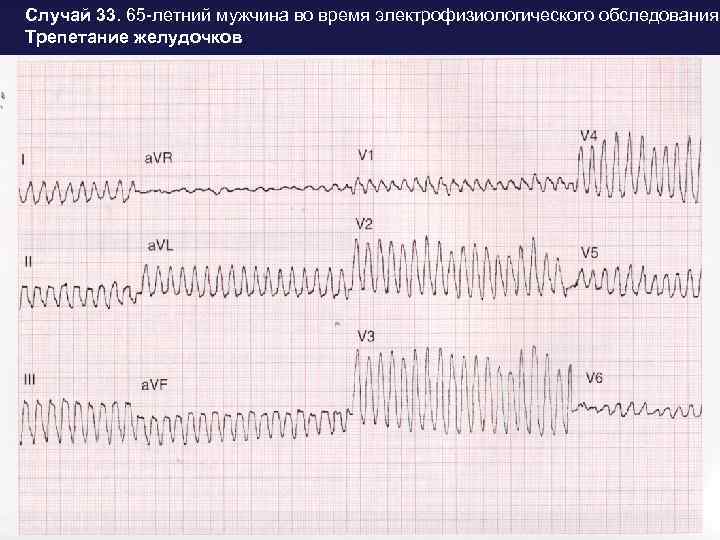 Случай 33. 65 -летний мужчина во время электрофизиологического обследования Трепетание желудочков. 