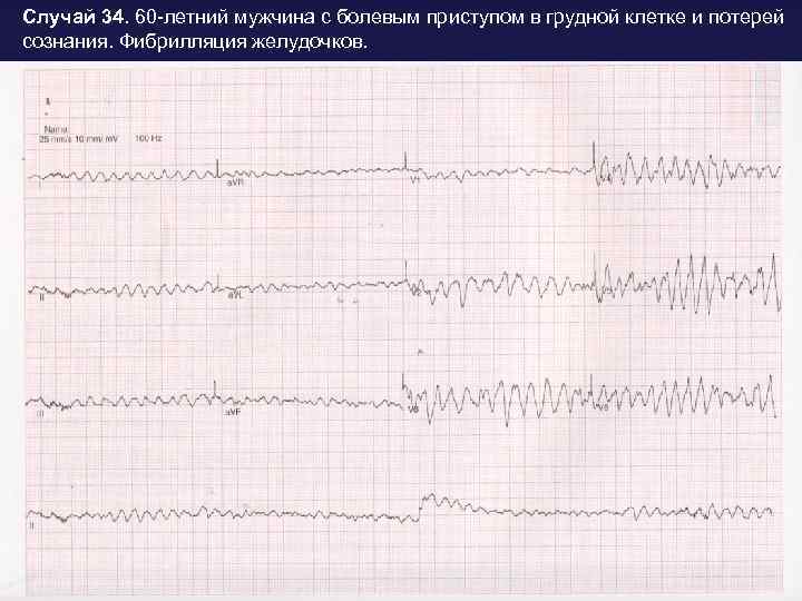 Случай 34. 60 -летний мужчина с болевым приступом в грудной клетке и потерей сознания.