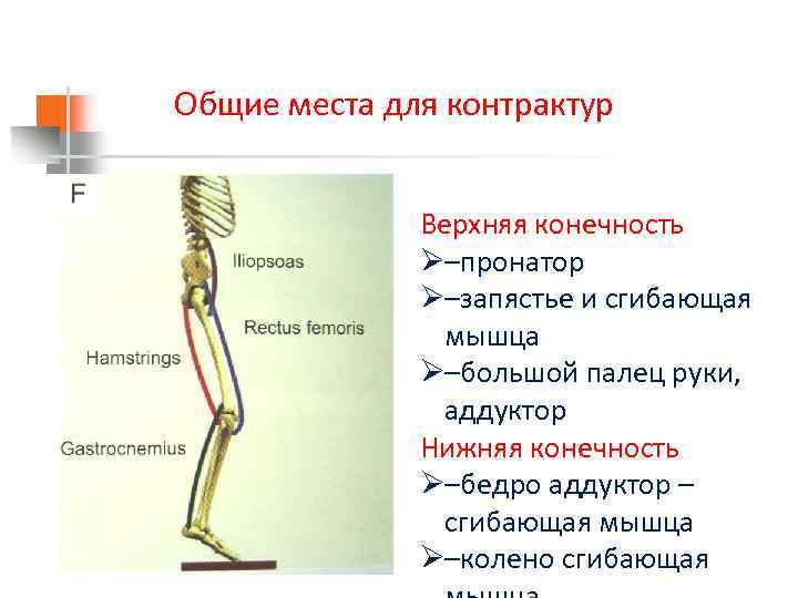 Общие места для контрактур Верхняя конечность Ø–пронатор Ø–запястье и сгибающая мышца Ø–большой палец руки,