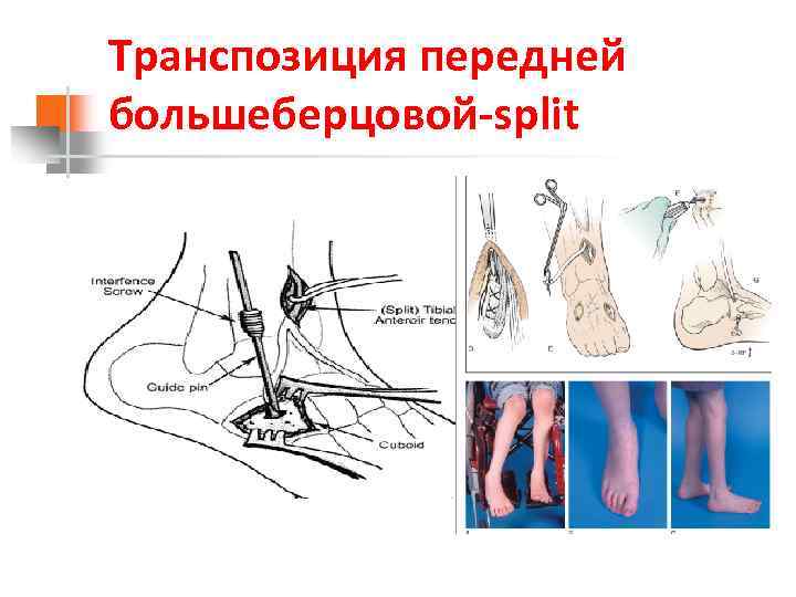Транспозиция передней большеберцовой-split 