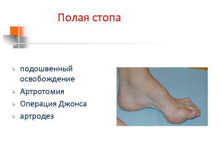 Полая стопа Ø Ø подошвенный освобождение Артротомия Операция Джонса артродез 