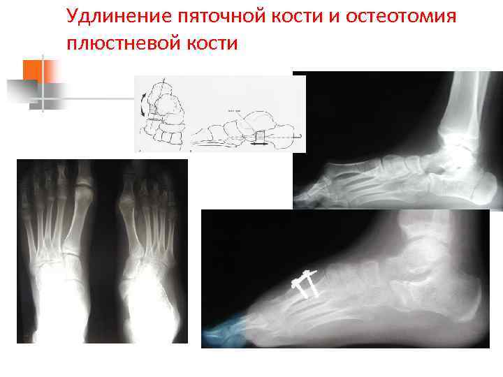 Удлинение пяточной кости и остеотомия плюстневой кости 
