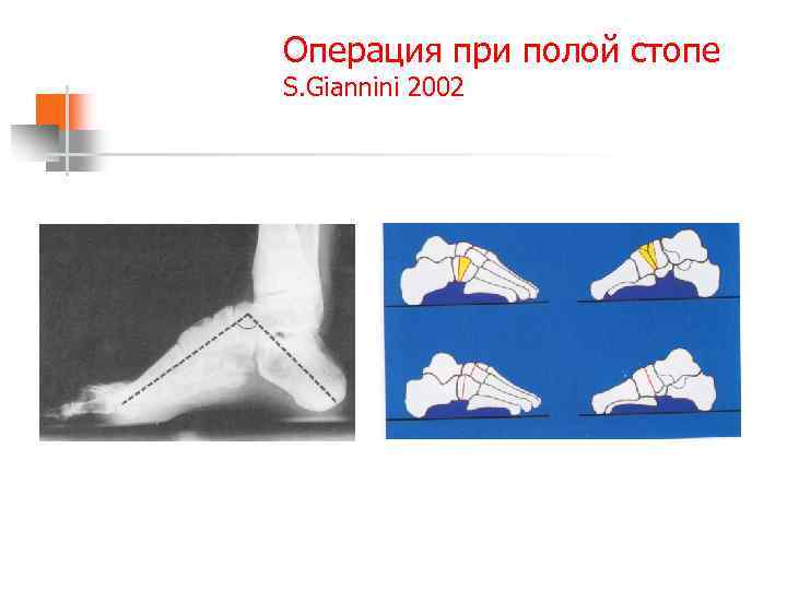 Операция при полой стопе S. Giannini 2002 