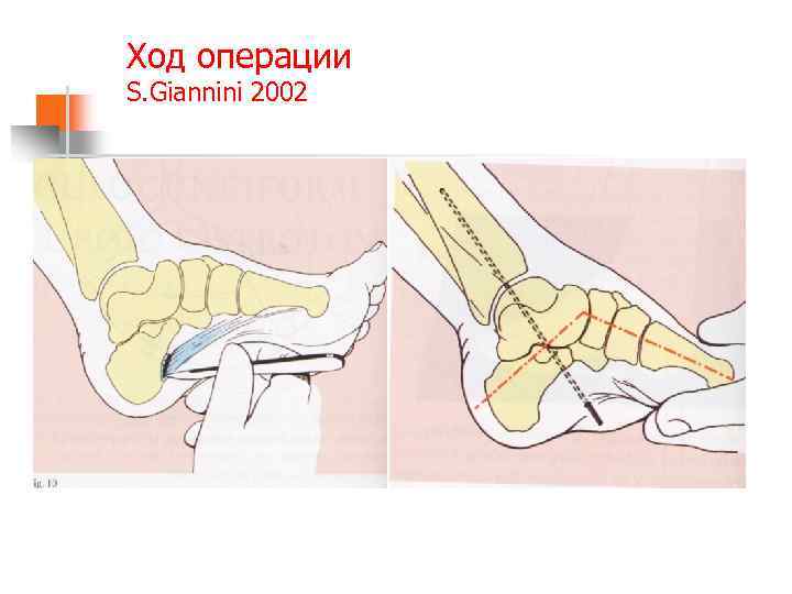Ход операции S. Giannini 2002 