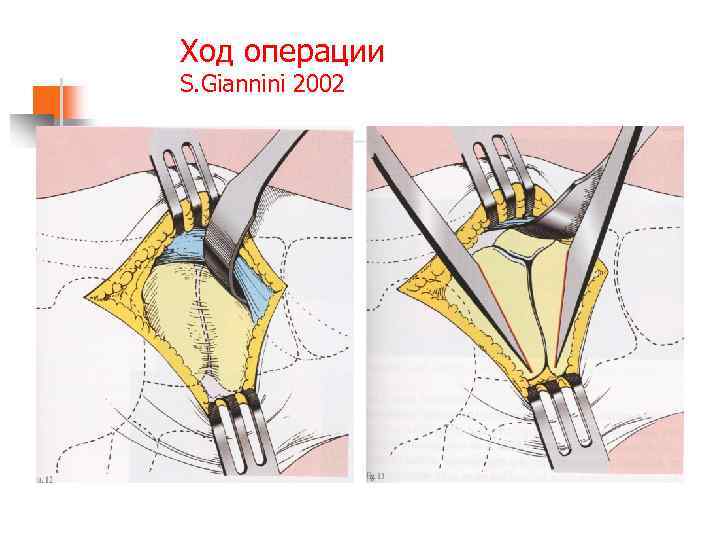 Ход операции S. Giannini 2002 