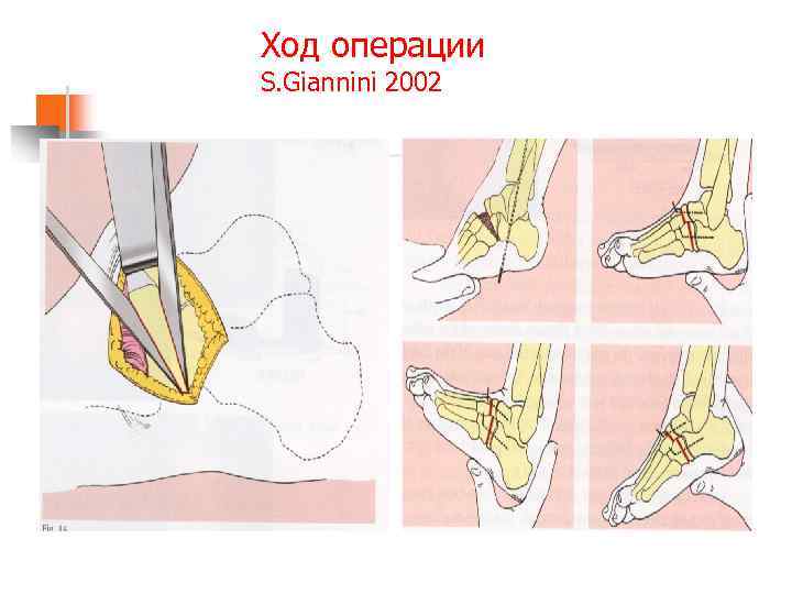 Ход операции S. Giannini 2002 