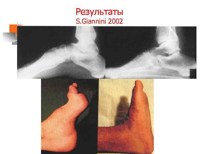 Результаты S. Giannini 2002 