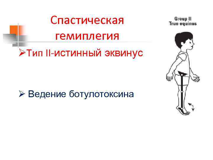 Спастическая гемиплегия ØТип II-истинный эквинус Ø Ведение ботулотоксина 