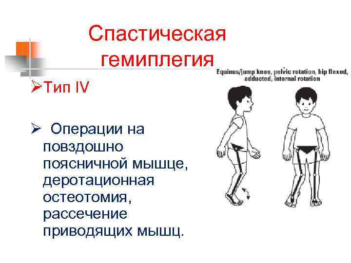 Спастическая гемиплегия ØТип IV Ø Операции на повздошно поясничной мышце, деротационная остеотомия, рассечение приводящих