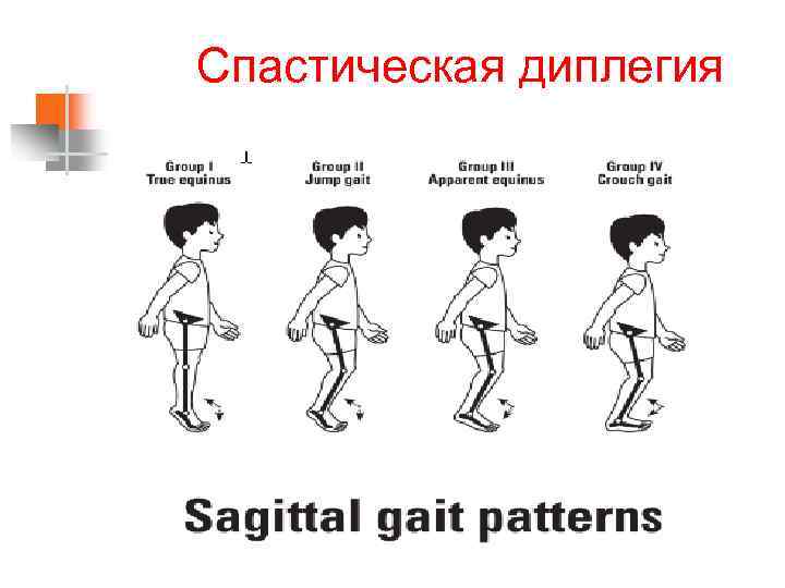 Спастическая диплегия 