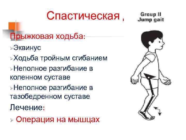 Спастическая диплегия Прыжковая ходьба: Эквинус ØХодьба тройным сгибанием ØНеполное разгибание в коленном суставе ØНеполное