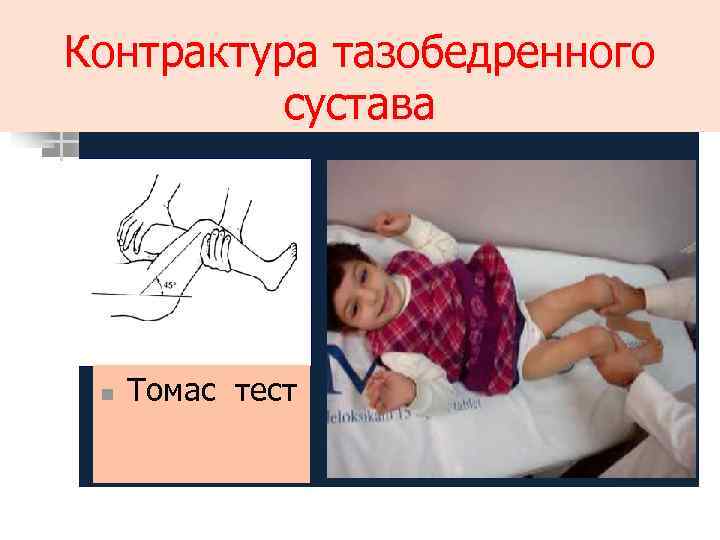 Контрактура тазобедренного сустава n Томас тест 