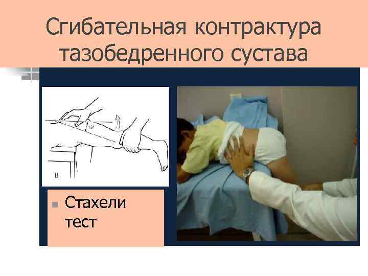 Сгибательная контрактура тазобедренного сустава n Стахели тест 