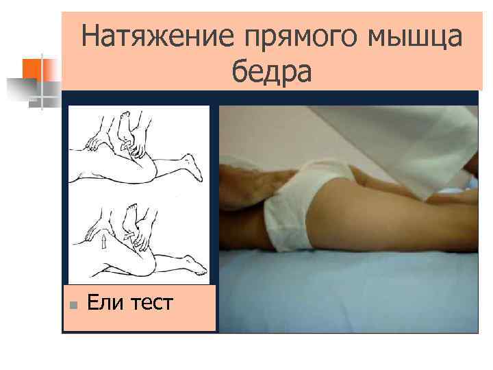 Натяжение прямого мышца бедра n Ели тест 