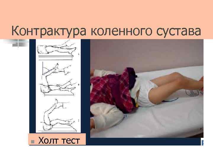 Контрактура коленного сустава n Холт тест 