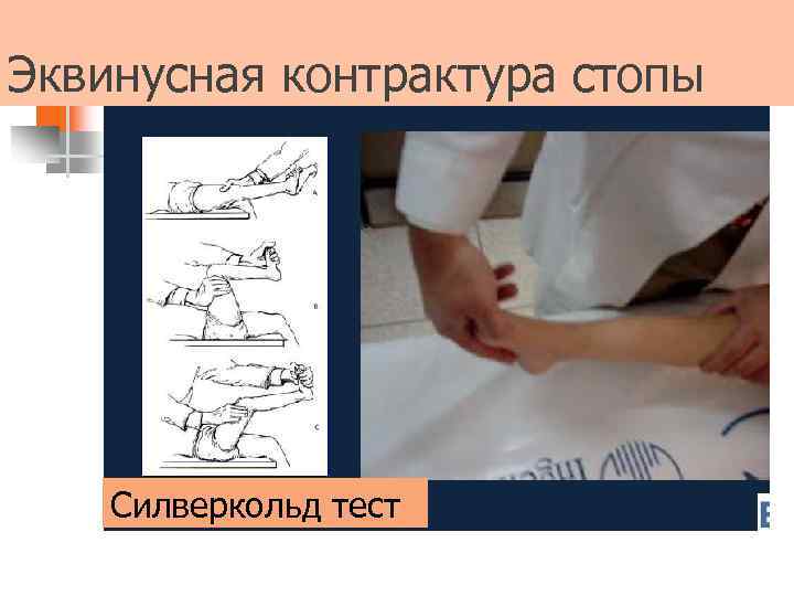 Эквинусная контрактура стопы Силверкольд тест 