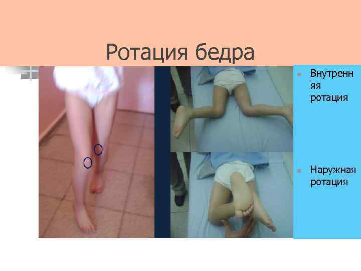 Ротация бедра n n Внутренн яя ротация Наружная ротация 