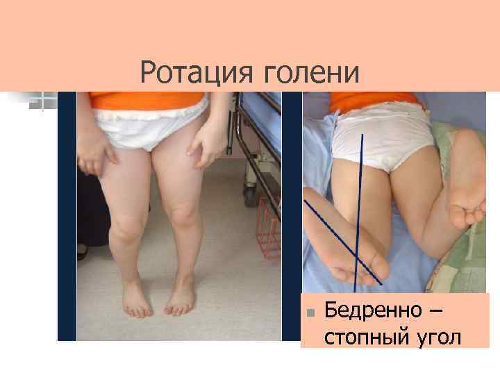 Ротация голени n Бедренно – стопный угол 