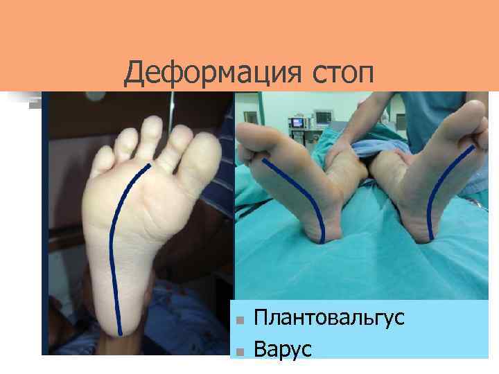 Деформация стоп n n Плантовальгус Варус 
