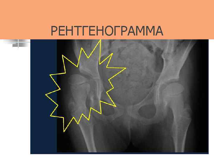 РЕНТГЕНОГРАММА 