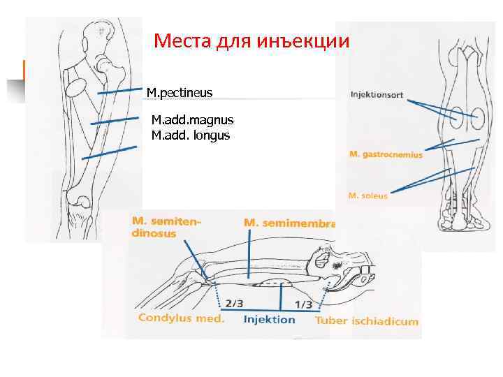 Места для инъекции M. pectineus M. add. magnus M. add. longus 
