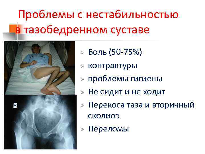  Проблемы с нестабильностью в тазобедренном суставе Ø Ø Ø Боль (50 -75%) контрактуры