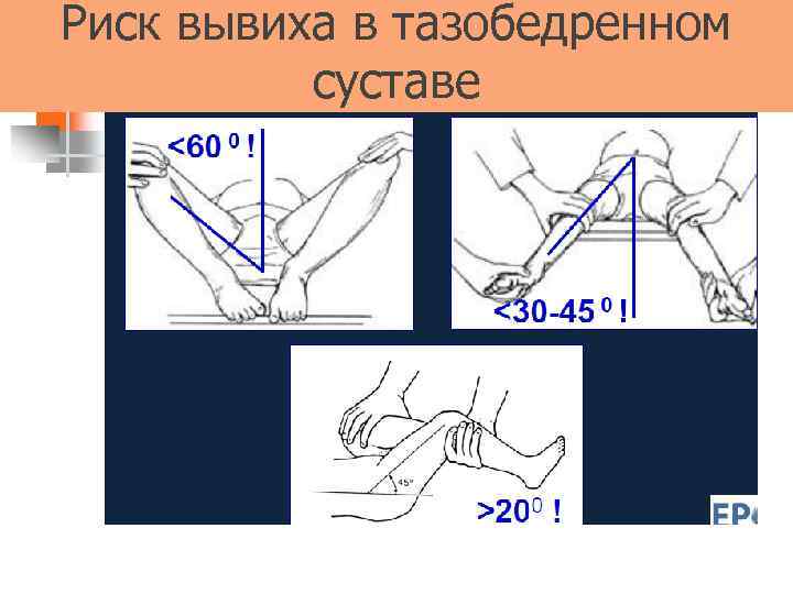 Риск вывиха в тазобедренном суставе 