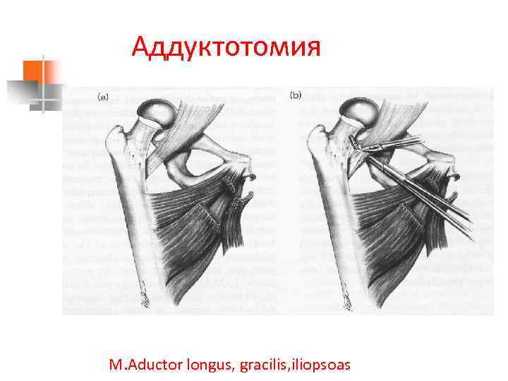 Аддуктотомия M. Aductor longus, gracilis, iliopsoas 