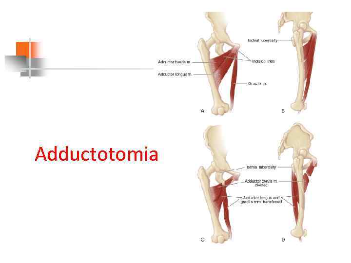Adductotomia 