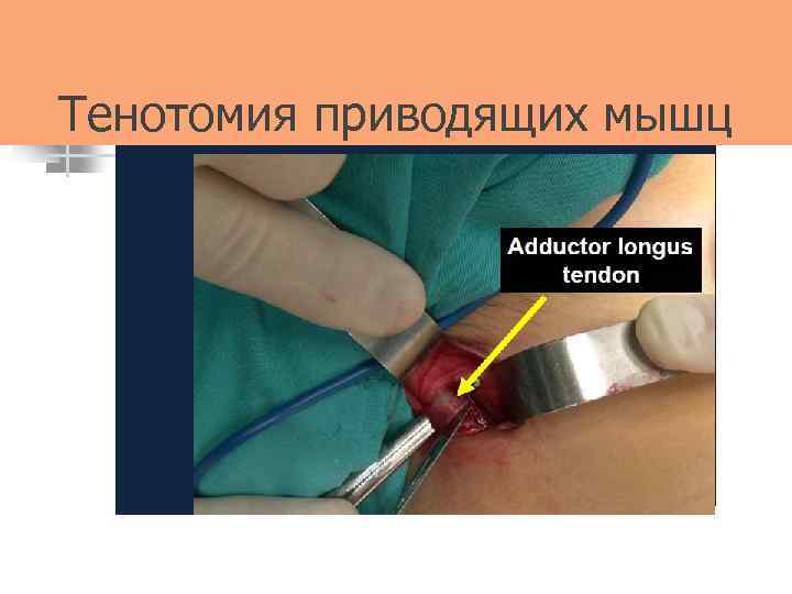 Тенотомия приводящих мышц 