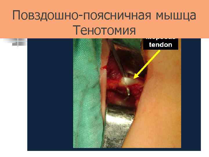 Повздошно-поясничная мышца Тенотомия 