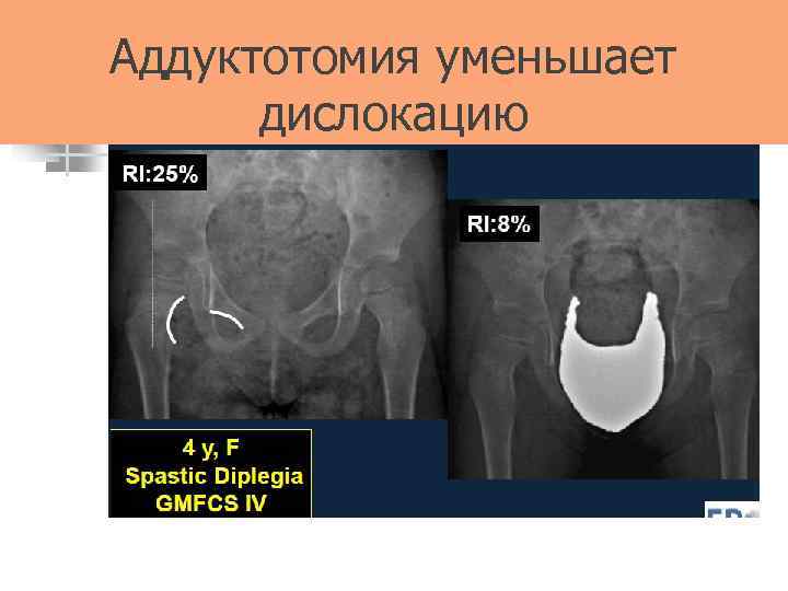 Аддуктотомия уменьшает дислокацию 
