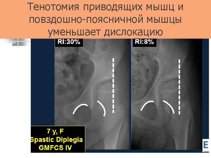 Тенотомия приводящих мышц и повздошно-поясничной мышцы уменьшает дислокацию 