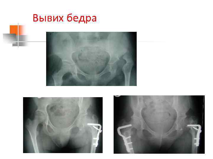 Вывих бедра 