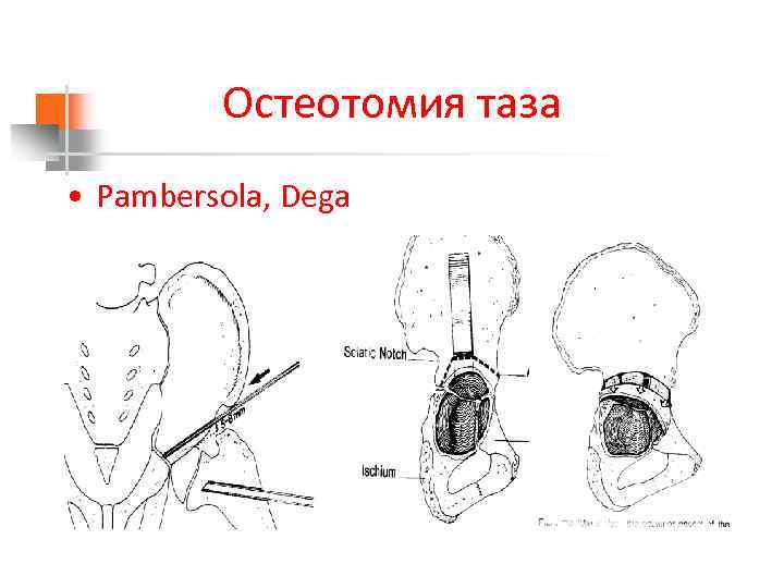Остеотомия таза • Pambersola, Dega 