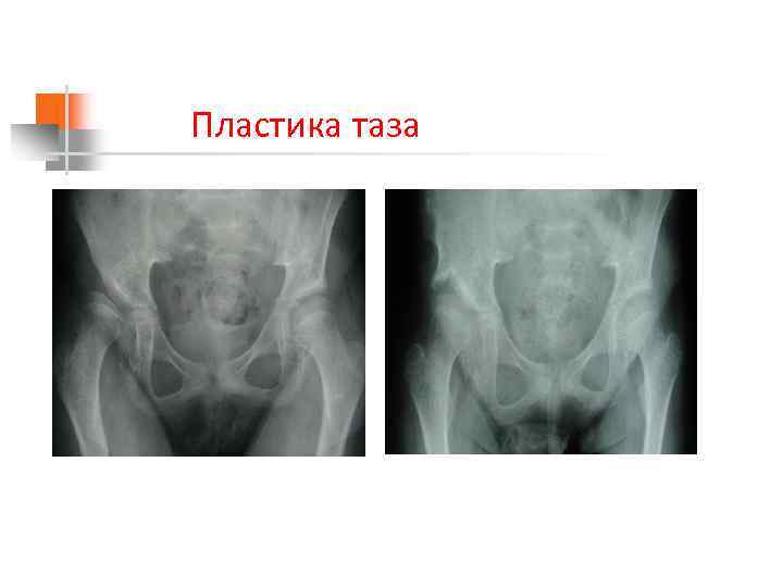 Пластика таза 