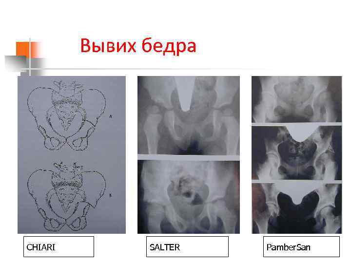 Вывих бедра CHIARI SALTER Pamber. San 
