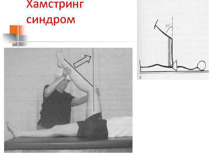 Хамстринг синдром 