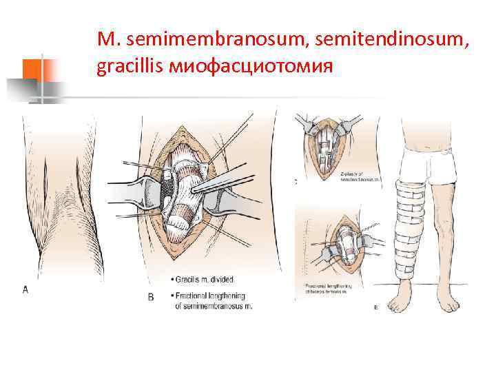M. semimembranosum, semitendinosum, gracillis миофасциотомия 