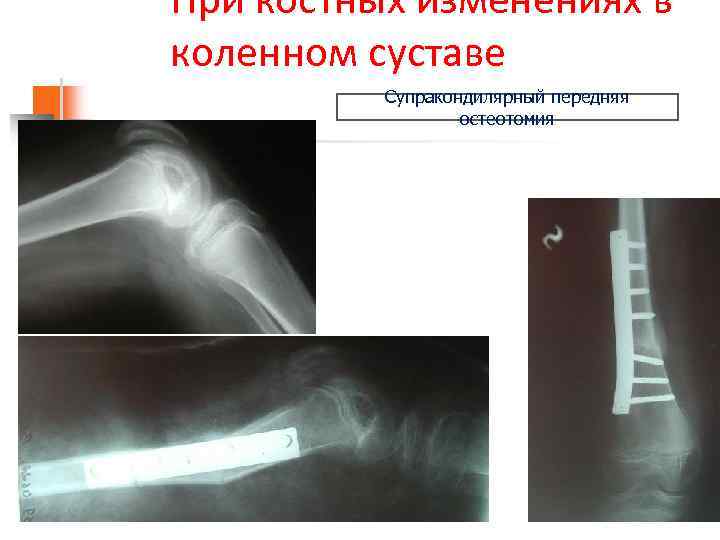 При костных изменениях в коленном суставе Супракондилярный передняя остеотомия 