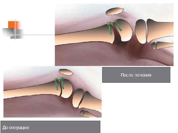После лечения До операции 