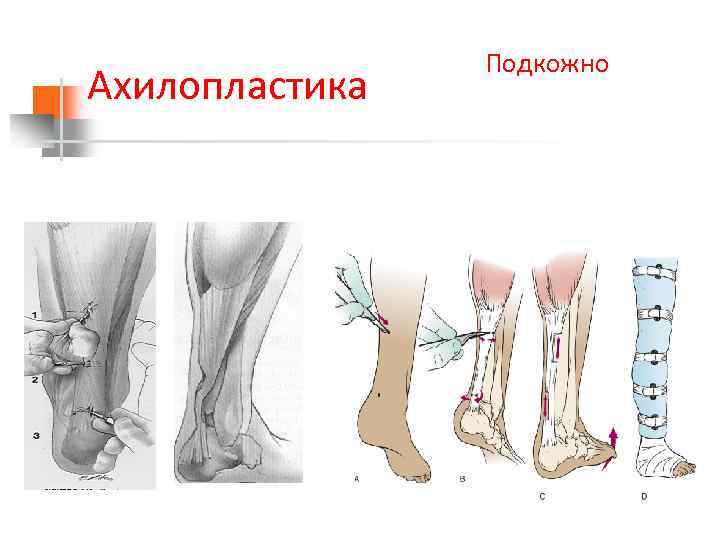 Ахилопластика Подкожно 