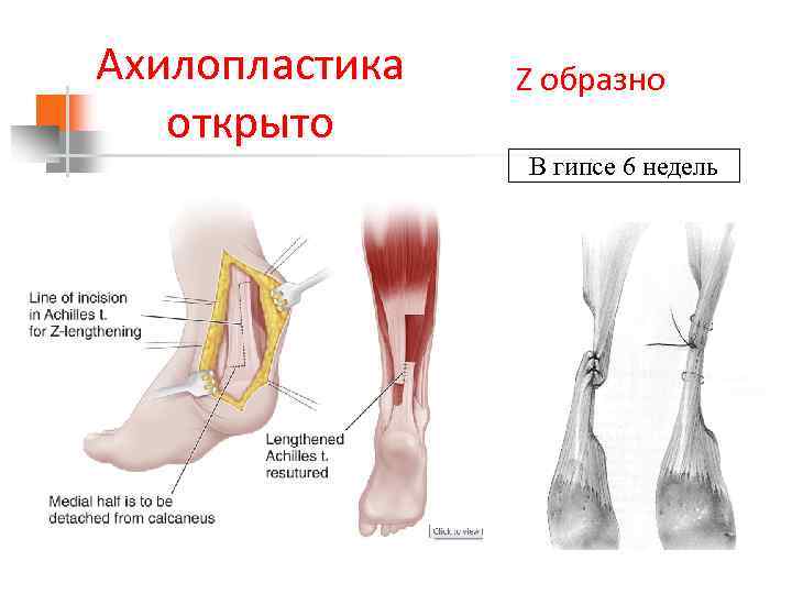 Ахилопластика открыто Z образно В гипсе 6 недель 