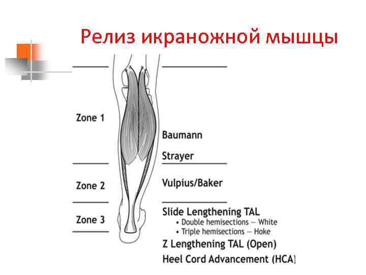 Релиз икраножной мышцы 