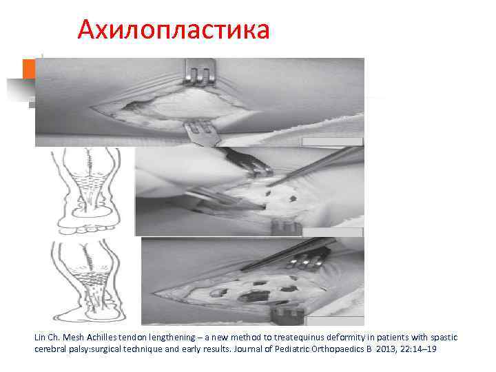 Ахилопластика. Lin Ch. Mesh Achilles tendon lengthening – a new method to treatequinus deformity