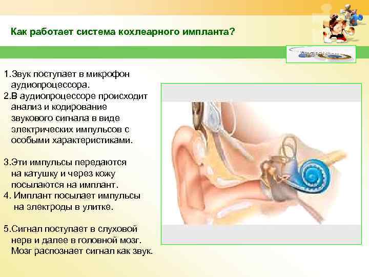 Как работает система кохлеарного импланта? www. themegallery. com 1. Звук поступает в микрофон аудиопроцессора.