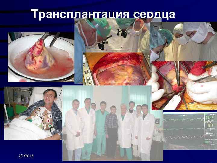 Трансплантация сердца 2/1/2018 