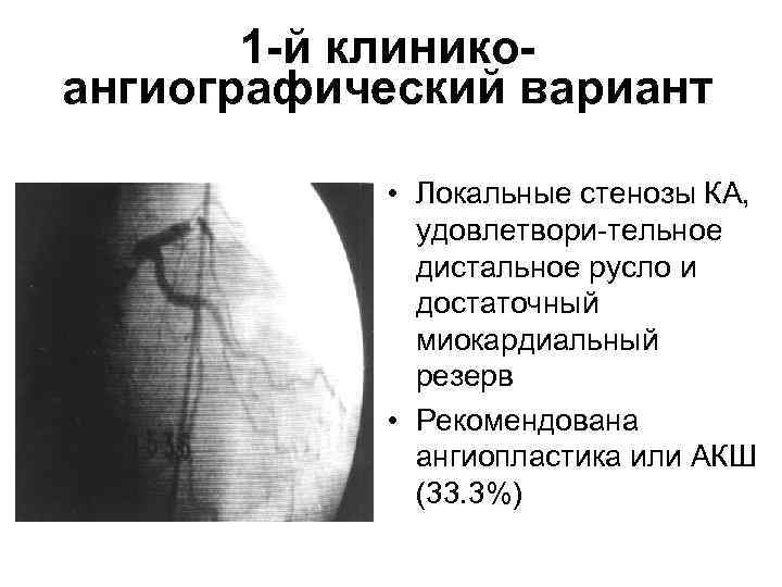 1 -й клиникоангиографический вариант • Локальные стенозы КА, удовлетвори-тельное дистальное русло и достаточный миокардиальный