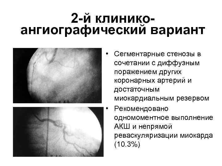 2 -й клиникоангиографический вариант • Сегментарные стенозы в сочетании с диффузным поражением других коронарных