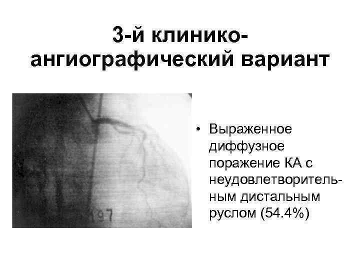 3 -й клиникоангиографический вариант • Выраженное диффузное поражение КА с неудовлетворительным дистальным руслом (54.